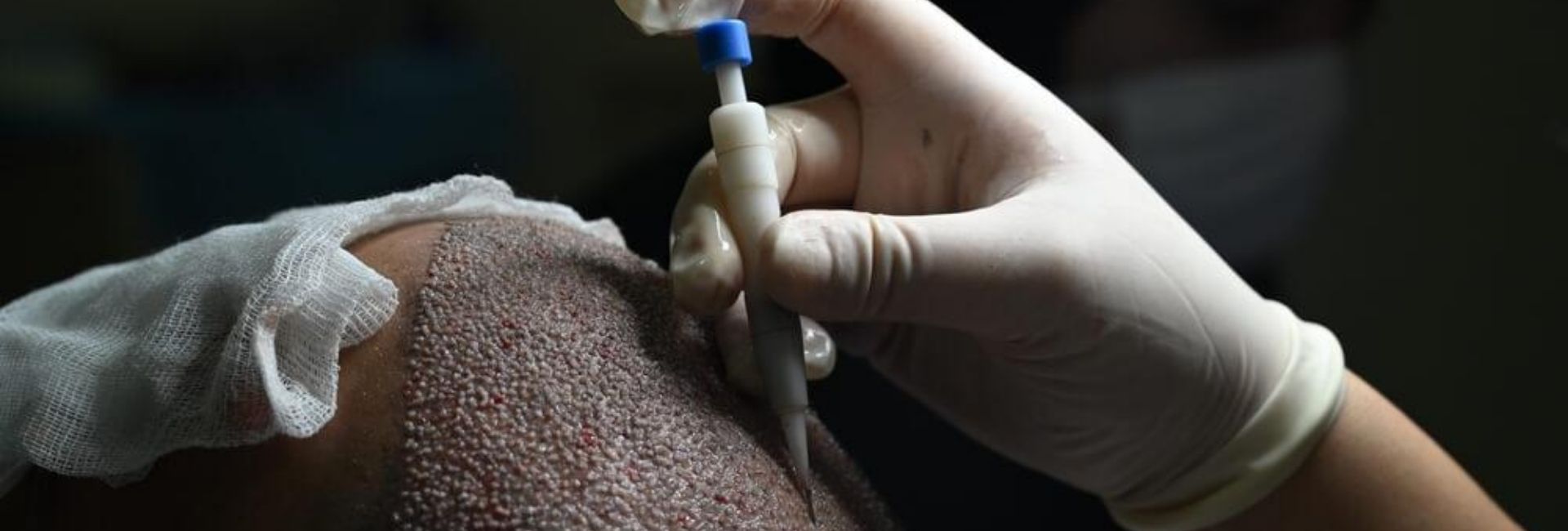 DHI Haartransplantation