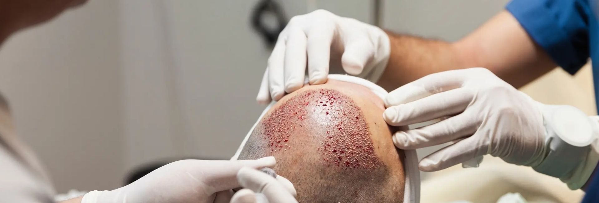 FUE Haartransplantation