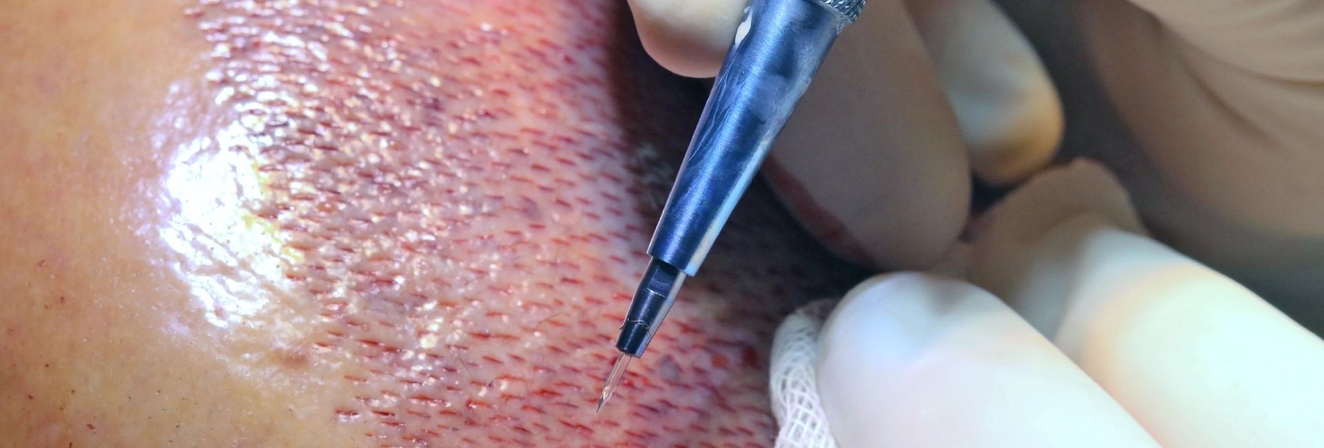 Sapphire FUE Haartransplantation