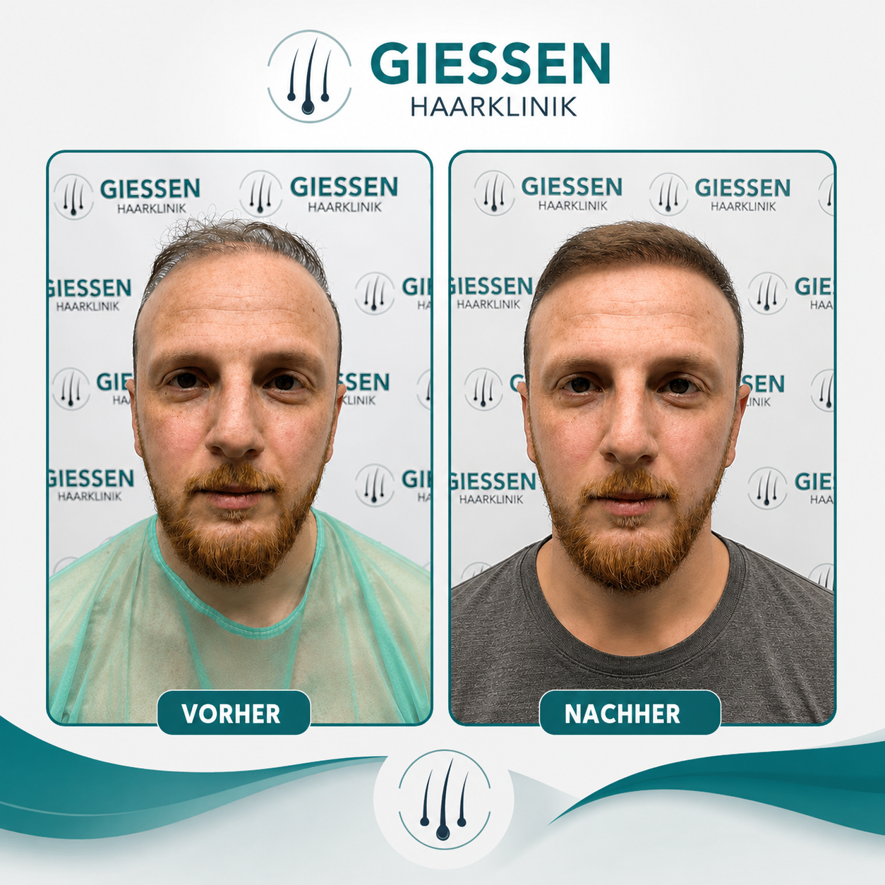 Giessen Haar Ergebnis 2