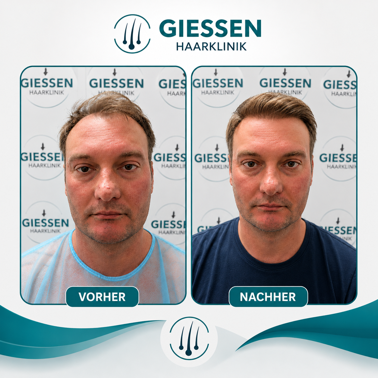Giessen Haar Ergebnis 1
