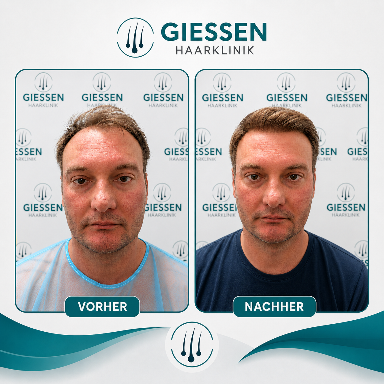 Giessen Haar Ergebnis 1